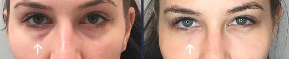 Dark Circles tear trough