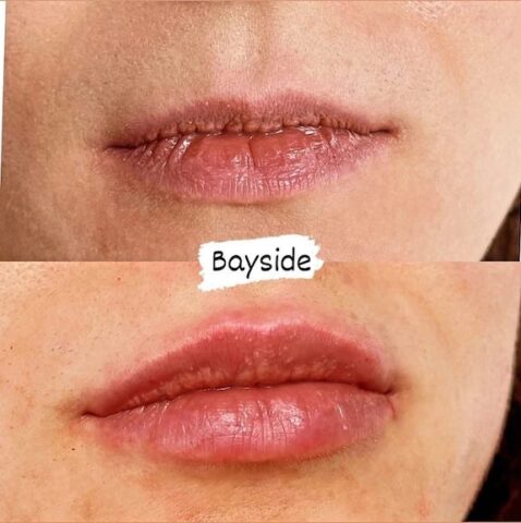 lip before and after lip filler