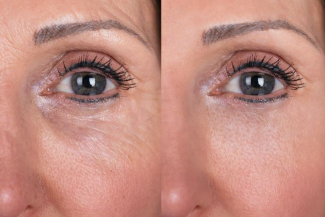 Sunekos at Bayside beauty Clinic Stoke on Trent