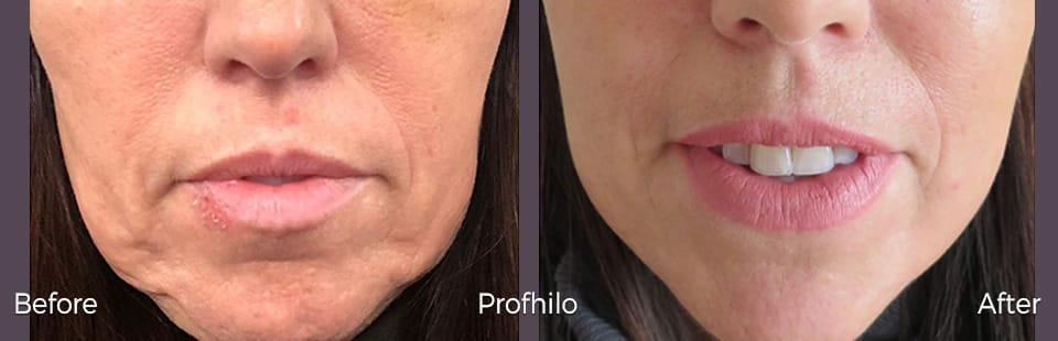 Profhilo jowl lift