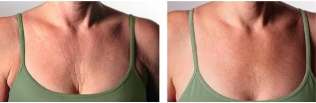 Pfrohilo at Bayside Beauty Clinic Stoke on Trent