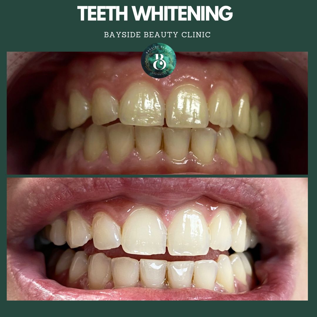 Teeth Whitening Treatment