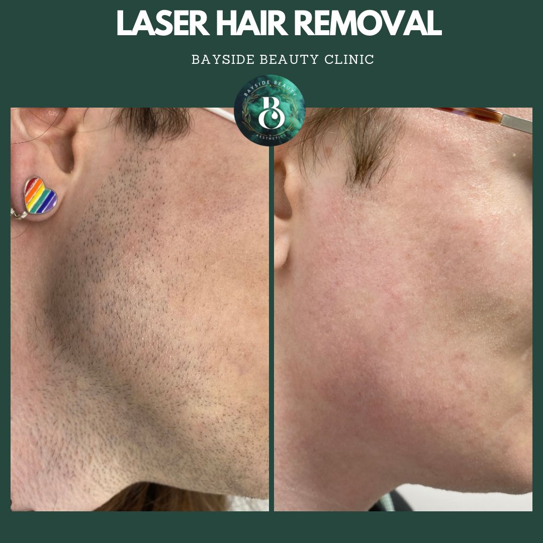Laser hair removal treatment Stoke-on-Trent