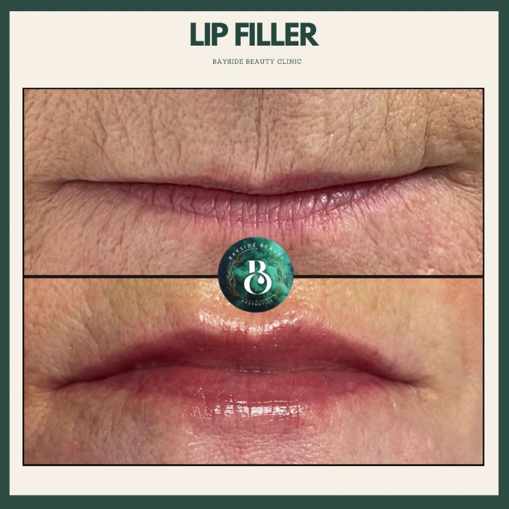 Aesthetics Treatments - Lip Filler Stoke-on-Trent