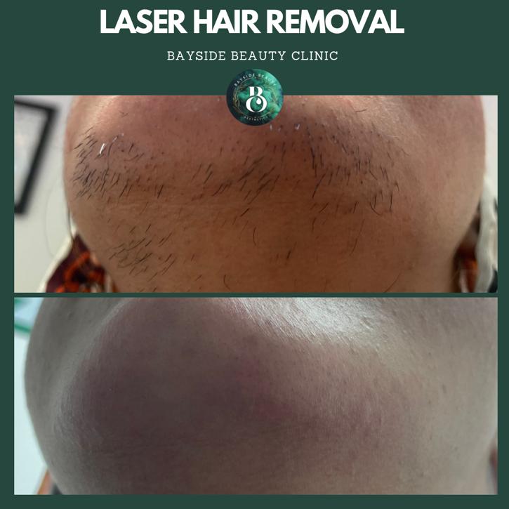 laser hair removal in Stoke-On-Trent - Candela GentleMax Pro