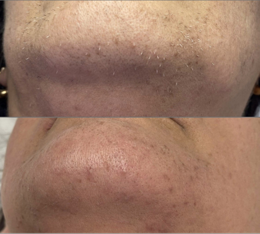 electrolysis treatment in Stoke-on-Trent